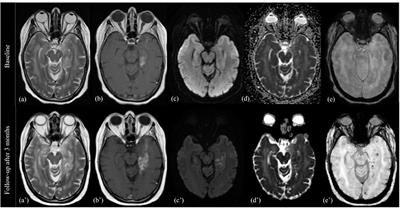 Regorafenib in Glioblastoma Recurrence: How to Deal With MR Imaging Treatments Changes